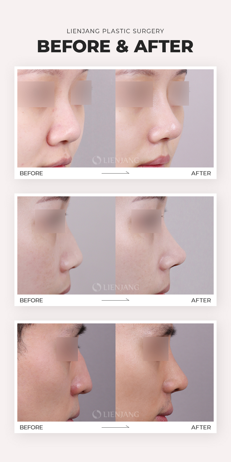 Before and after cases of revision rhinoplasty