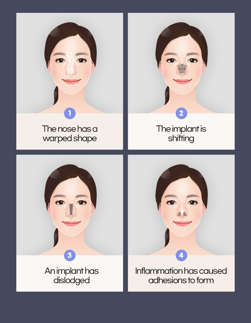 When to do revision rhinoplasty