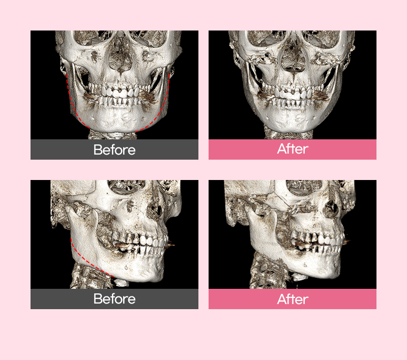 Before and after CT imaging