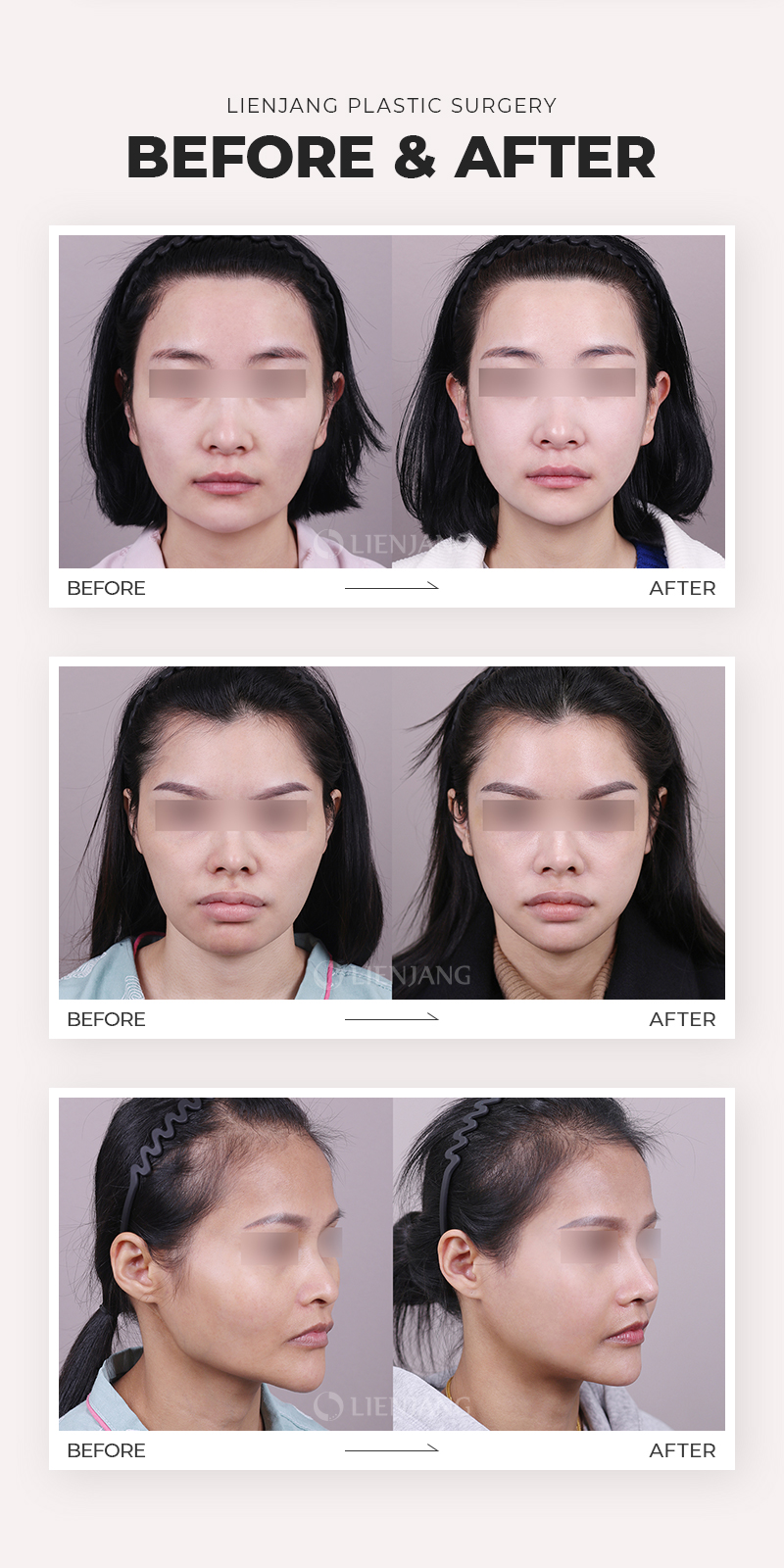 Square Jaw reduction Before and After photos