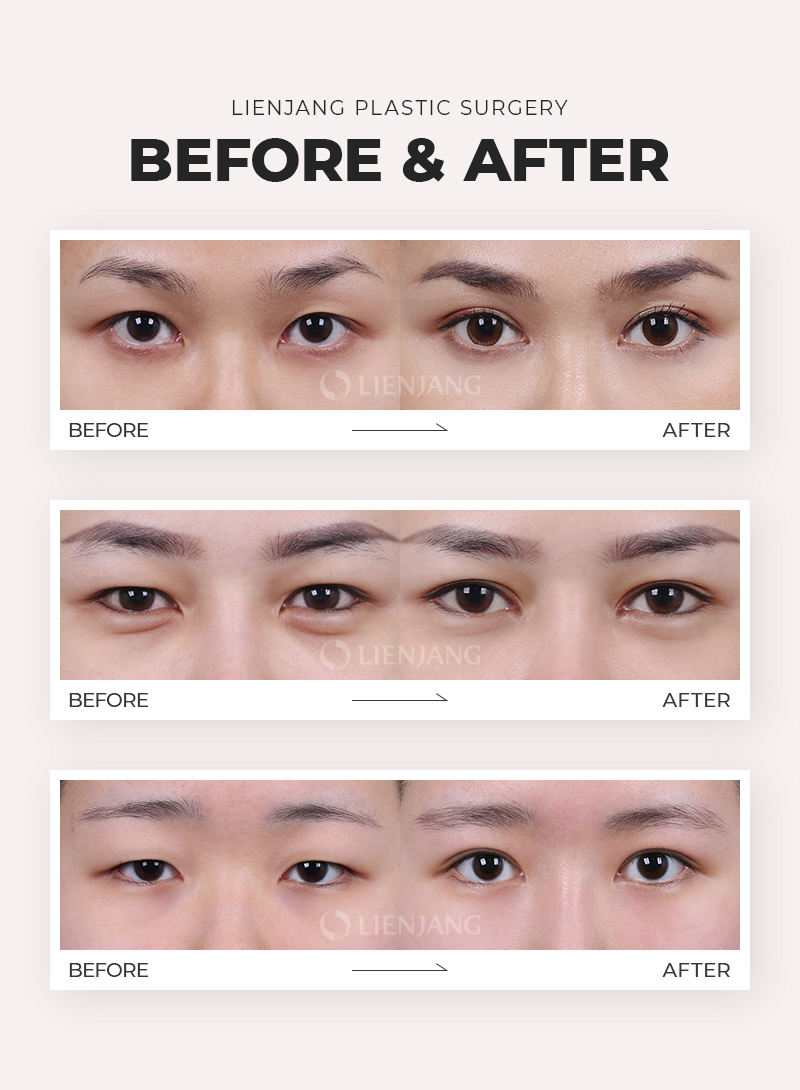 Before and after canthoplasty