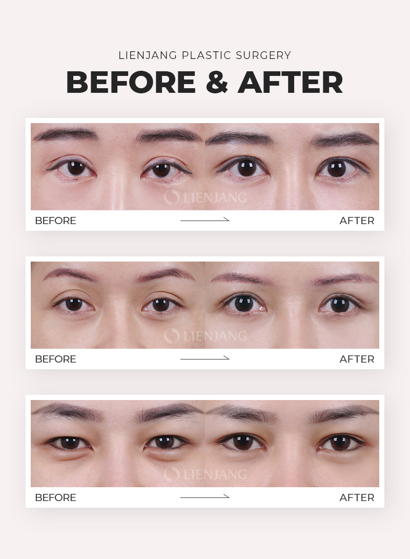 Before and after ptosis correction