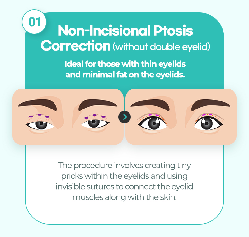 Non-incisional ptosis correction without double eyelid