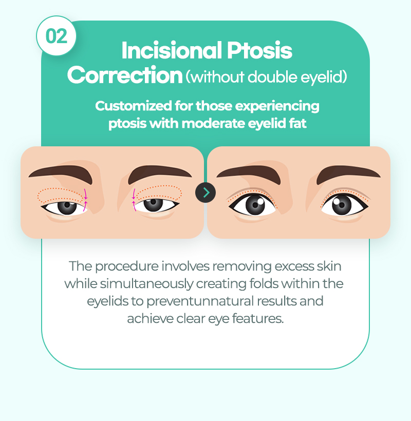Incisional ptosis correction without double eyelid