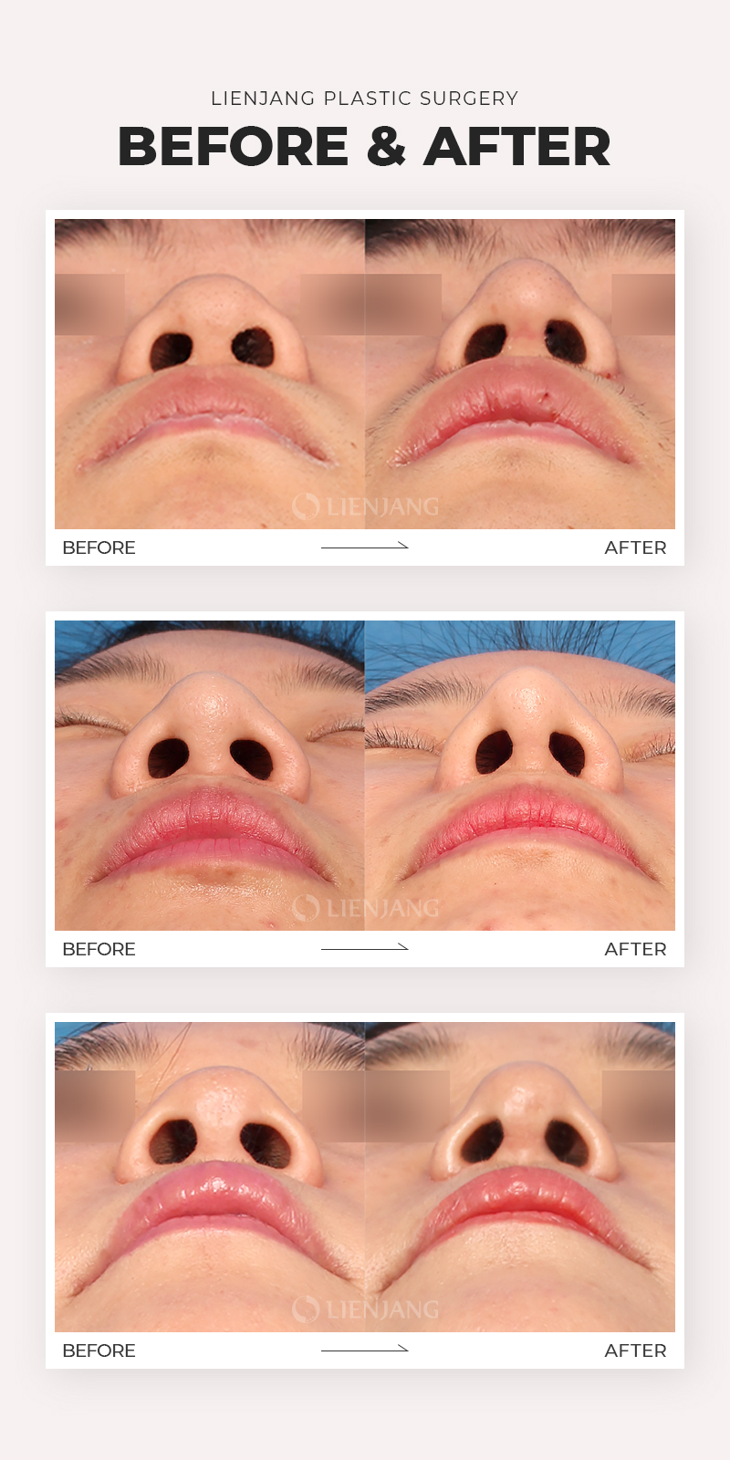 Before and after examples for Lienjang Alar reduction, nostril reduction, or Alarplasty in Korea