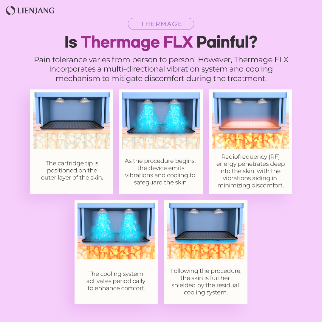 Thermage FLX cooling system for enhanced comfort during treatment.