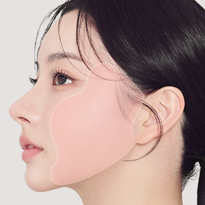 Minimally invasive SMAS facelift at Lienjang Plastic Surgery Center for a lifted, youthful facial appearance