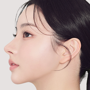 Results of SMAS facelift surgery at Lienjang Plastic Surgery Center: Enhanced facial contours and youthful skin.